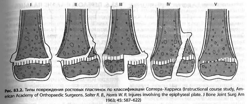 Пластина роста. Эпифизарные переломы большеберцовой кости. Перелом эпифизеолиз большеберцовой кости. Эпифизеолиз (перелом Салтера-Харриса);.