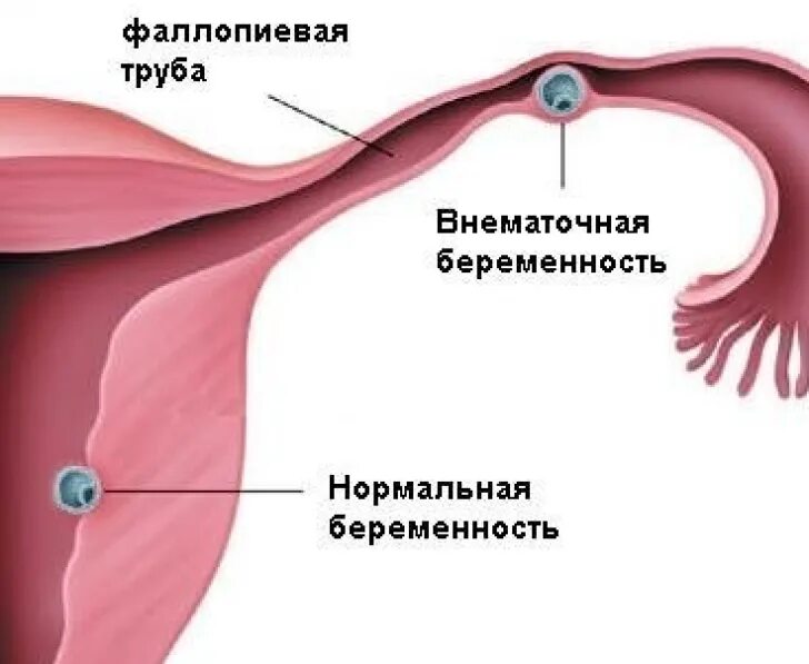Фаллопиевы трубы это. Матка и трубы внематочная беременность. ампулярная внематочная беременность. внематочная беременность и нормальная. внематочная беременность в трубе.