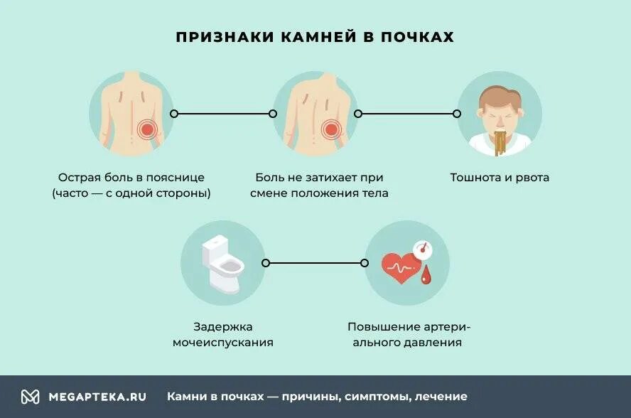 Камень выходит из почки симптомы у мужчин. Камни в посках симптом. камнитв почках симптомы. кампив почках симптомы.