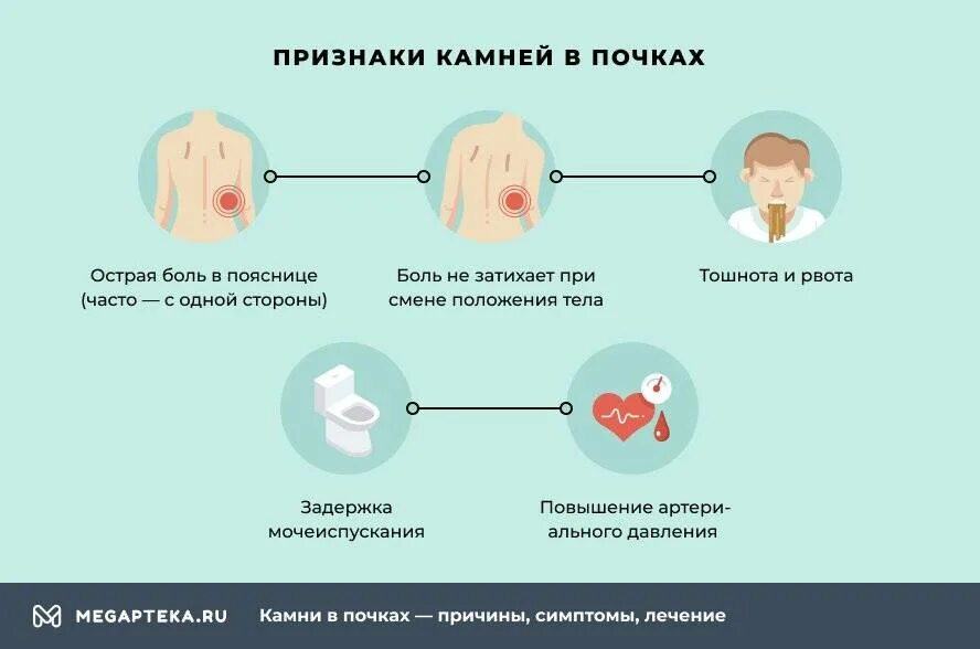 Камни в посках симптом. Кампив почках симптомы. Симптомы при камнях в почках.