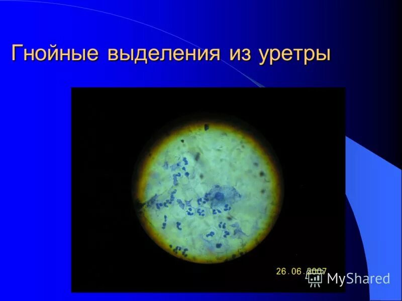 Гнойные выделения из уретры. Микроскопия мазка из уретры у мужчин норма. Из уретры выделяется жидкость. Причины выделения из уретры. Выделения из мочеиспускательного.