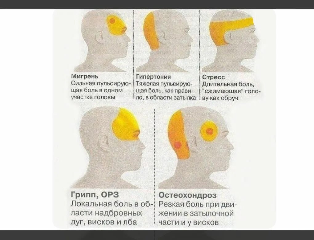 Купирование мигренозного приступа. Мигрень раз в год. Снятие головной боли. Мигрень лечение. Симптомы боли в голове.
