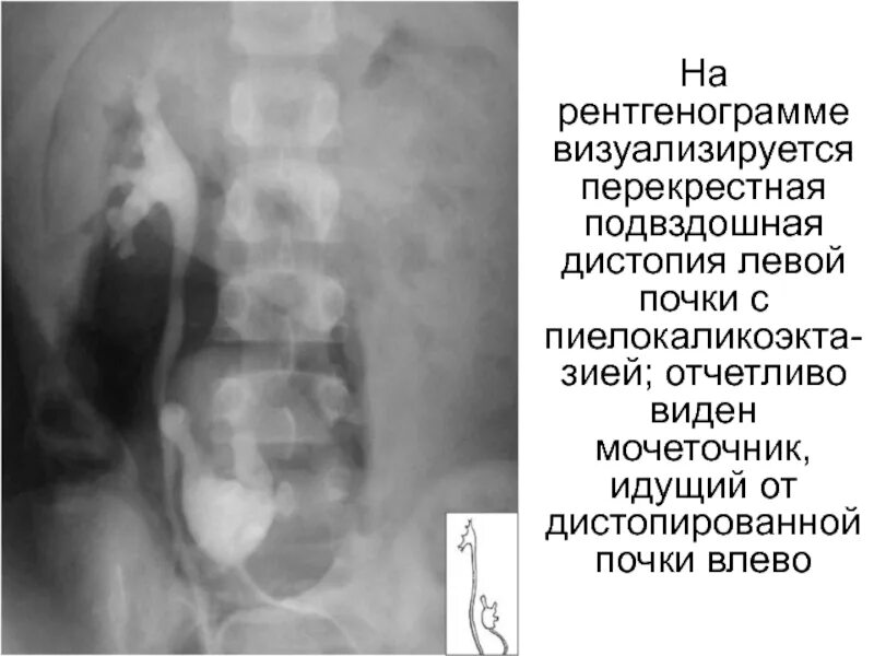 Почка не визуализируется