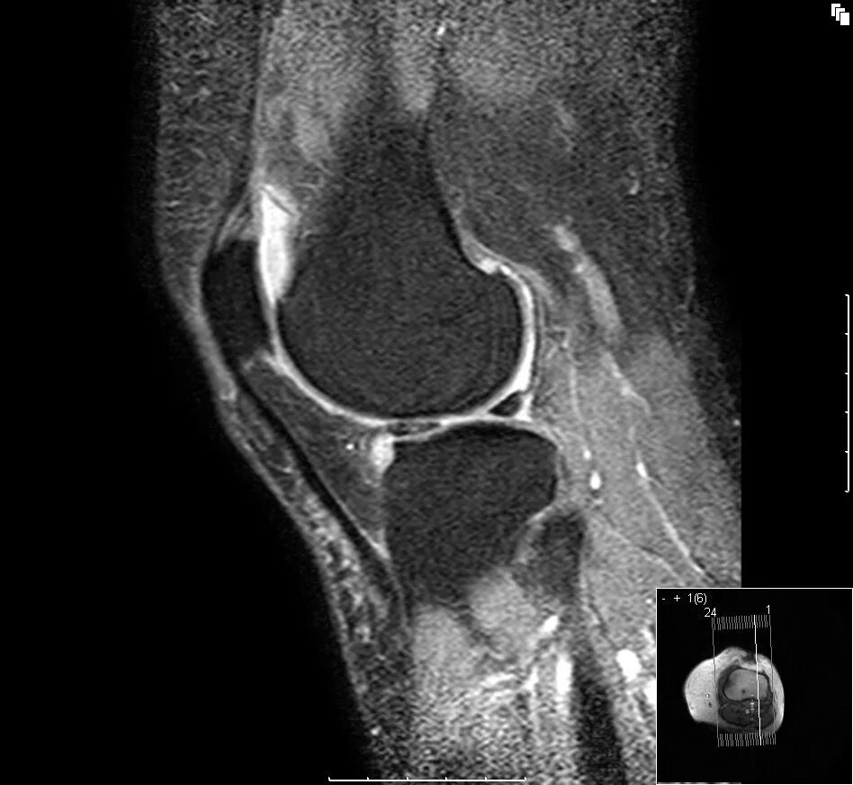 Киста мениска коленного сустава мрт. Гемартроз коленного сустава мрт. Разрыв медиального мениска коленного сустава рентген. Параменисковая киста медиального мениска.