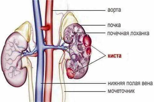 У мужчина киста будет. Киста синуса левой почки что это такое. Почечная киста лекарства.