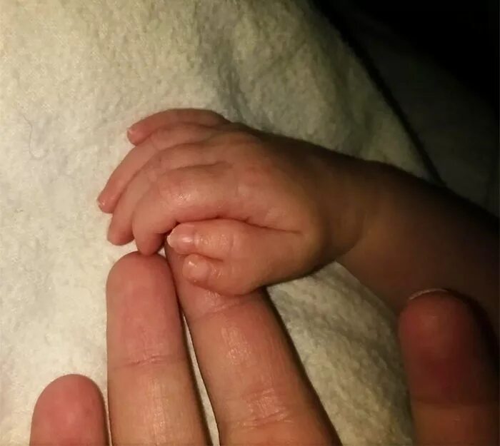 6 пальцев на руках у детей. Синдактилия полидактилия. Пальцы новорожденного на руках. Шестой пальчик на руке у новорожденного. Сросшиеся пальцы у новорожденных.