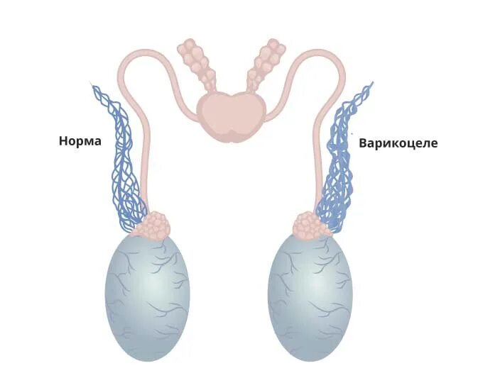 Варикоз вен семенного канатика. Ниже яиц у мужчин