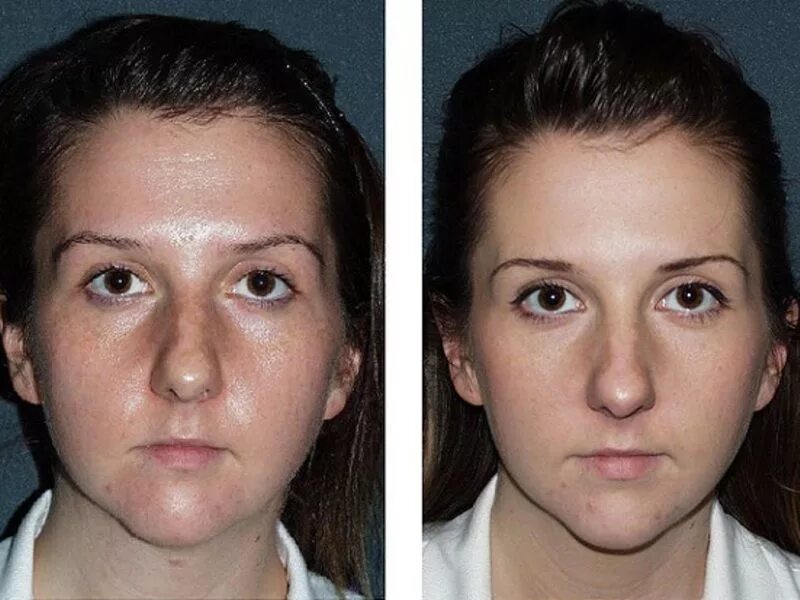 Маски для лица до и после. Химический пилинг гликолевой кислотой. Гликолевый пилинг до и после. Кислотный пилинг для лица до и после. Кислотный пиллинн для лица до и после.
