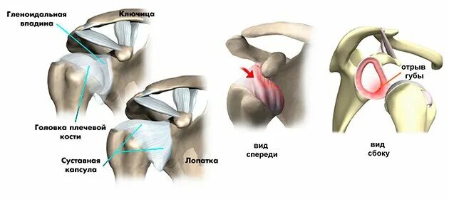 Повреждение губы плечевого сустава. Фиброзно-хрящевая губа гленоида плечевого. Гленоидальная впадина плечевого сустава. Суставная губа гленоида плечевого сустава. Суставная фиброзно-хрящевая губа гленоида.