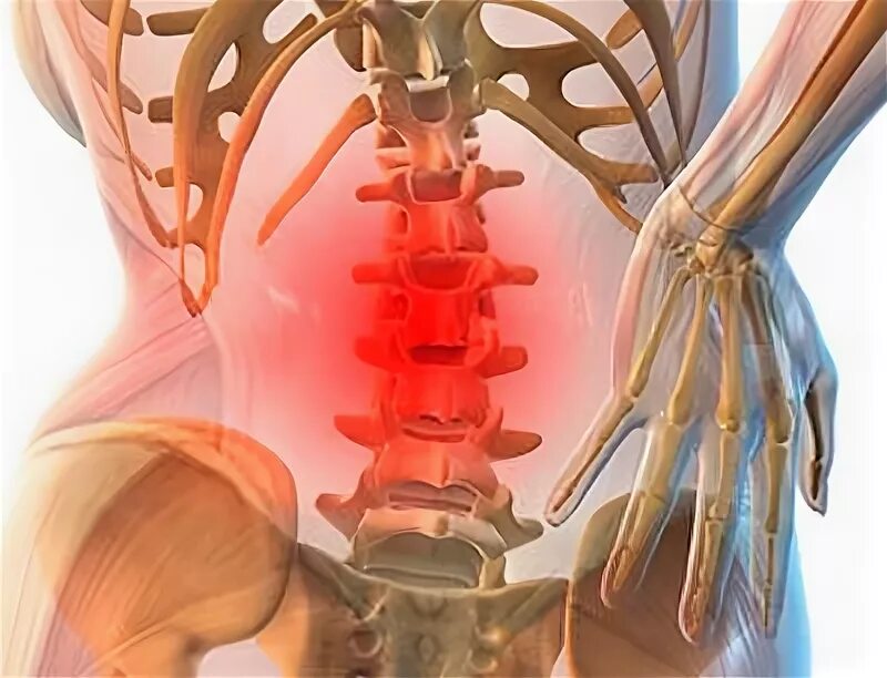 Болит сорванная спина. Люмбалгия поясничного отдела позвоночника что это такое. Что такое люмбалгия пояснично-крестцового. Люмбалгия поясничного крестцового отдела. Рентген позвоночника люмбалгия.