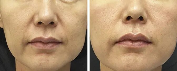 Фотоны 4 д омоложение. Фотоны 4 д омоложение. Matrix rf фракционное омоложение. Фотоны 4 д омоложение. Fotona 4d pro.