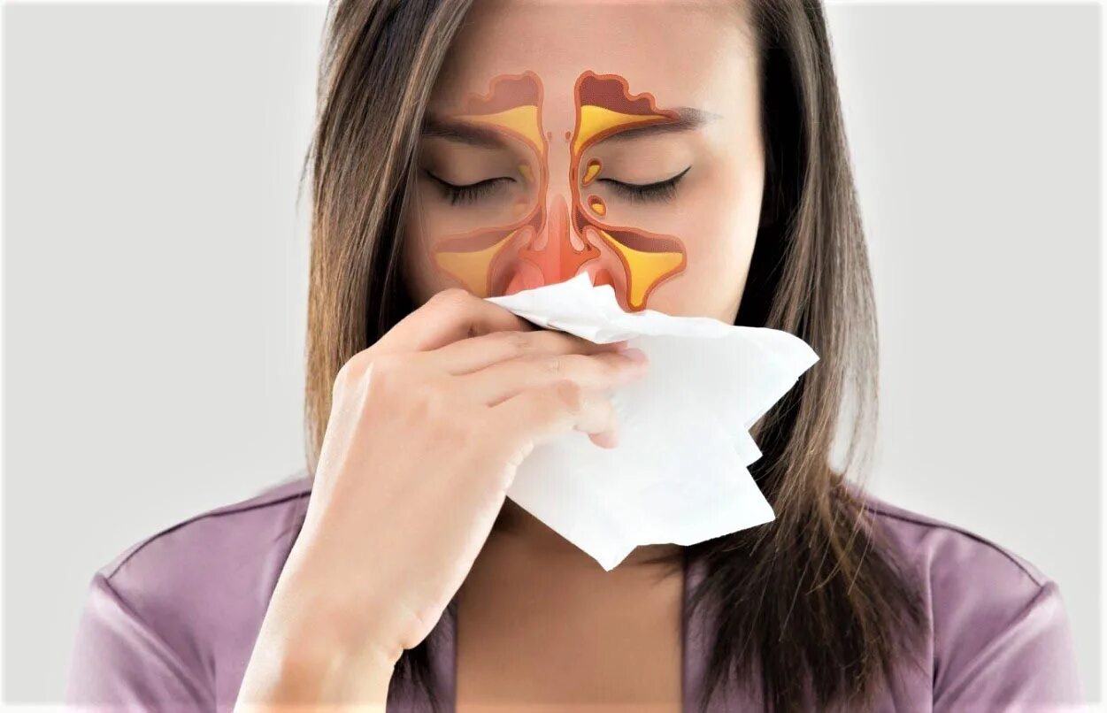 Заложенность носа боль в горле кашель. Ринит синусит гайморит. Синусит и аллергический ринит. Девушка насморк.