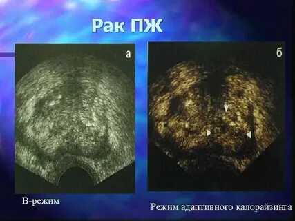 Диагнозы предстательной железы