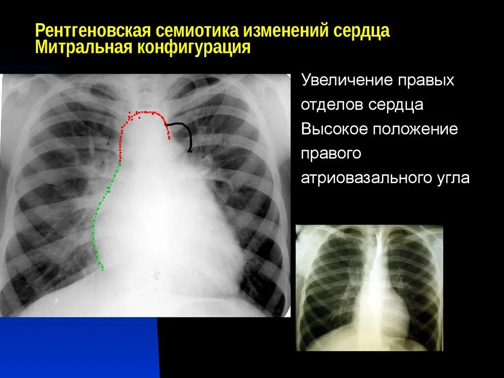 Легочная конфигурация сердца. Митральная конфигурация сердца на рентгенограмме.