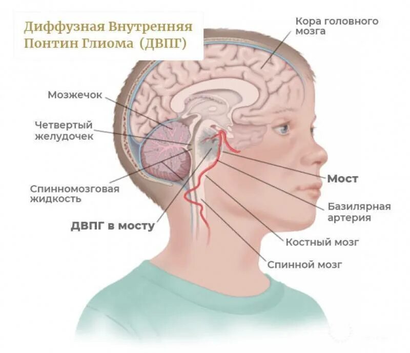 Рак мозгов симптомы. Глиома ствола головного мозга симптомы. Опухоль ствола головного мозга у детей. Опухоль глиома ствола головного мозга. Диффузная глиома Понтина.