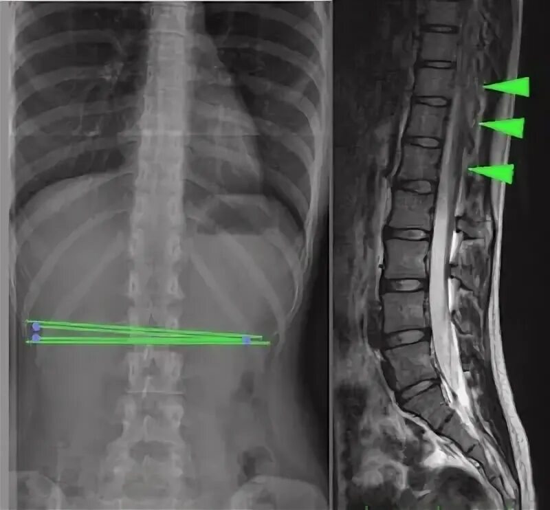 Spina Bifida anterior s1 позвонка. Spina Bifida рентген сколиоз.