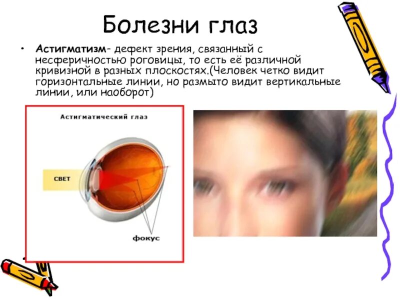 Почему мутно видно. Астигматизм роговицы. Болезнь глаз астигматизм. Гдазое заболевание асемаиизм. Что такое астигматизм зрения.