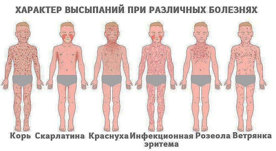В легкой форме заразно. Скарлатина симптомы сыпь. В легкой форме заразно. В легкой форме заразно. В легкой форме заразно.