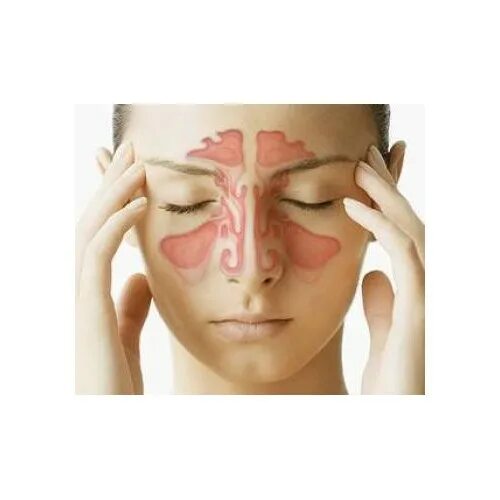 сама лечения гайморита