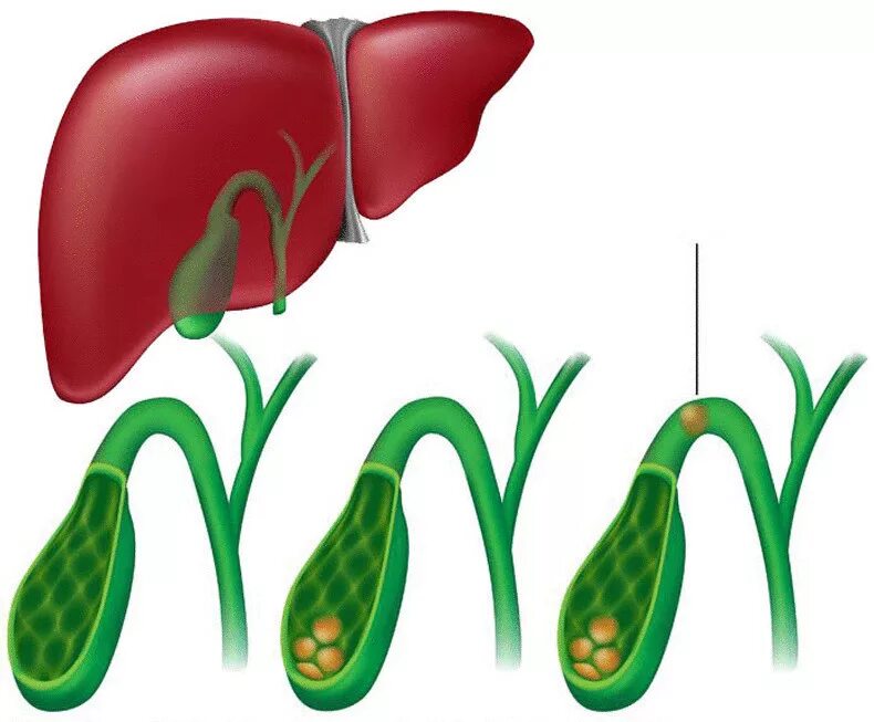 Желчный пузырь болит месяц. Болезни желчного пузыря. Печеночная колика изображение.
