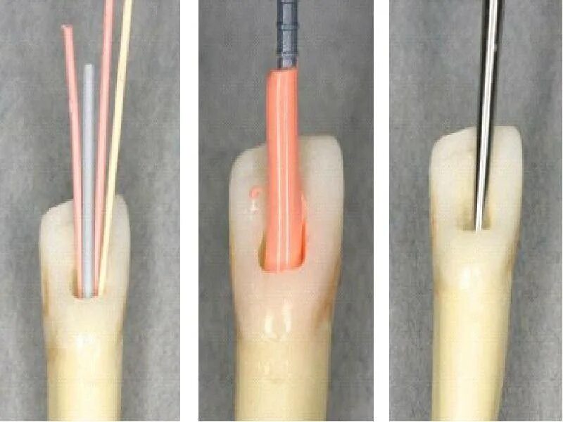 Штифты для обтурации корневых. Способ латеральной конденсации гуттаперчи. Метод латеральной конденсации холодной гуттаперчи. Пломбирование гуттаперчей латеральная конденсация. Пломбирование гуттаперчевыми штифтами методом латеральной конденсации.