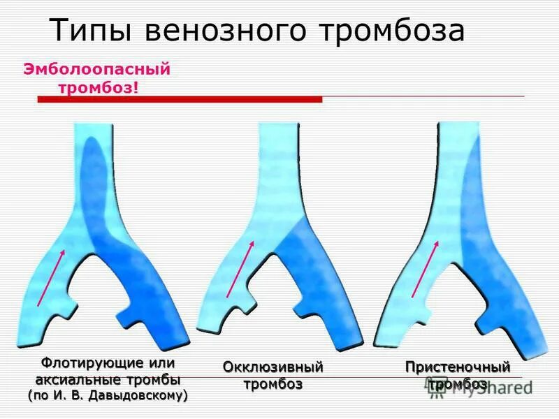 Окклюзионный и неокклюзионный тромбоз. Неокклюзирующий тромбоз. Типы тромбов. Окклюзионный тромбоз