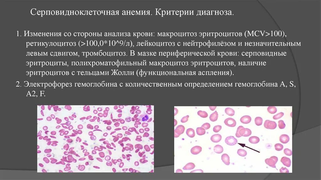 Синдром тельца. Серповидноклеточная анемия гистология. Серповидноклеточная анемия картина крови. Кровь при серповидноклеточной анемии. Серповидноклеточная анемия анализ крови.