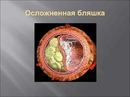 Есть ли бляшки