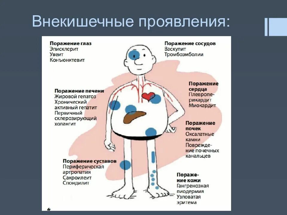 Болезнь крона лечение у взрослых кишечника. Болезнь крона проявления. Внекишечные проявления болезни крона. Заболевание крона что это такое симптомы.