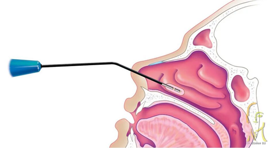 Вазомоторный ринит операция. Лазерная вазотомия нижних носовых раковин. Радиоволновая вазотомия. Радиоволновая вазотомия носовых раковин. Вазотомия носовых раковин операция