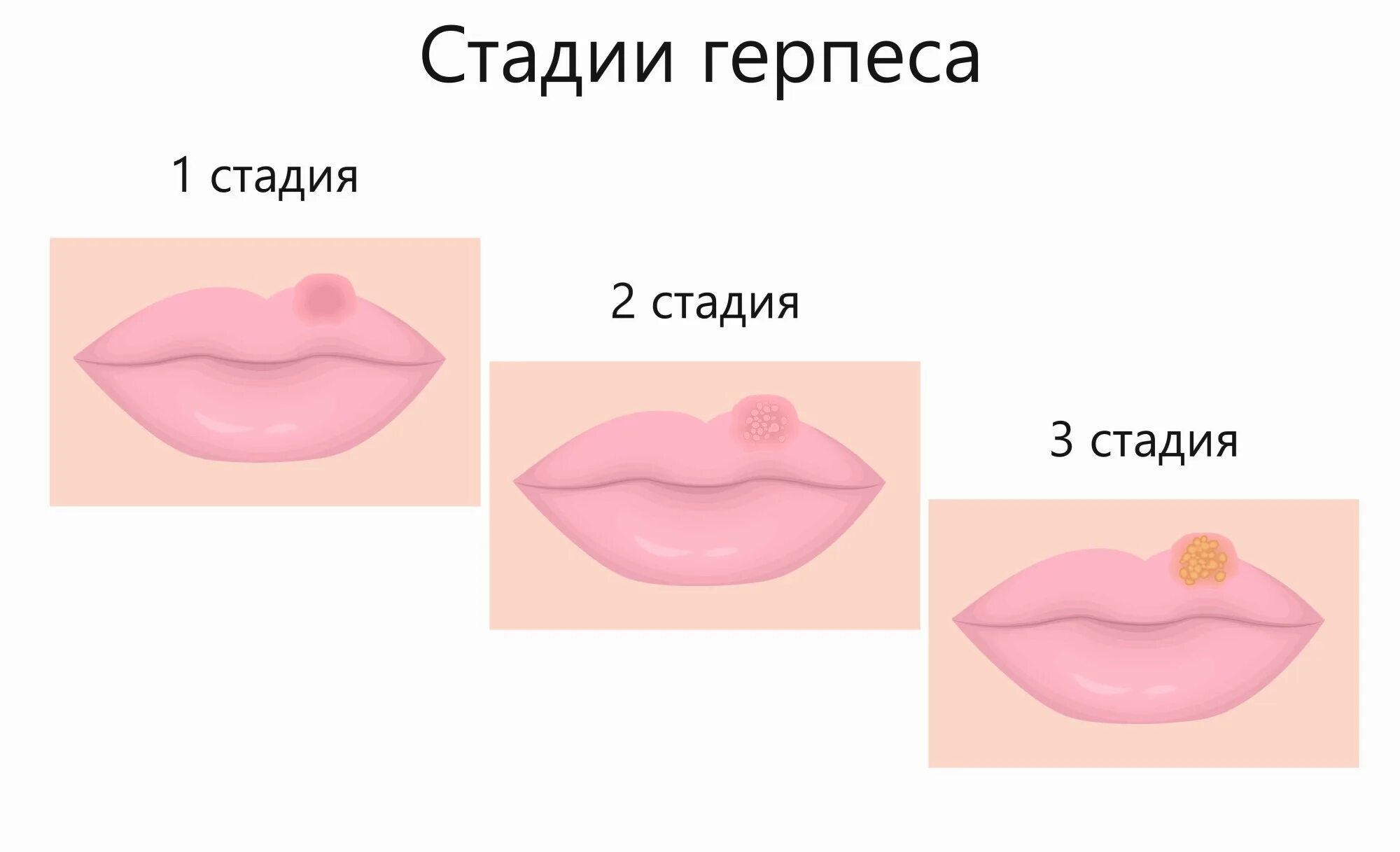 Этапы герпеса. Стадии развития герпеса на губах.