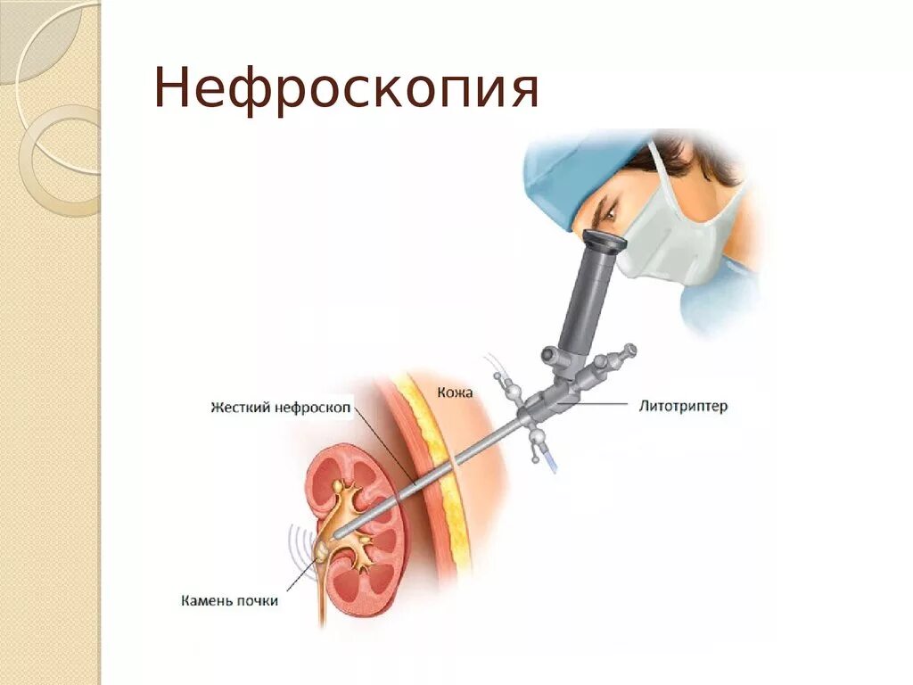 После дробления камней в мочеточнике. Нефролитотрипсия перкутанная лазерная. Дистанционная ударно-волновая литотрипсия (ДУВЛ). Контактная литотрипсия камней в почках. Лазерная контактная литотрипсия камня мочеточника.