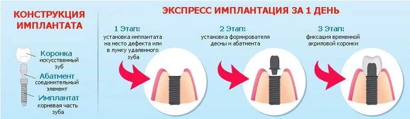 Срок импланта. Как устанавливают импланты зубов этапы. этапы имплантации зубов схема по времени. одноэтапная методика имплантации. этапы установления импланта зуба.