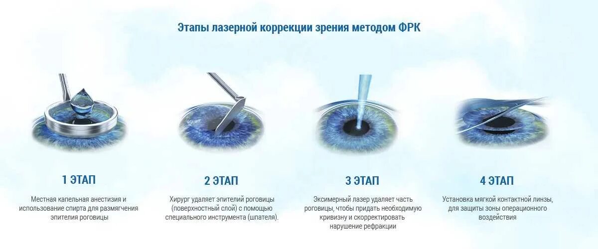Какую лазерную коррекцию выбрать