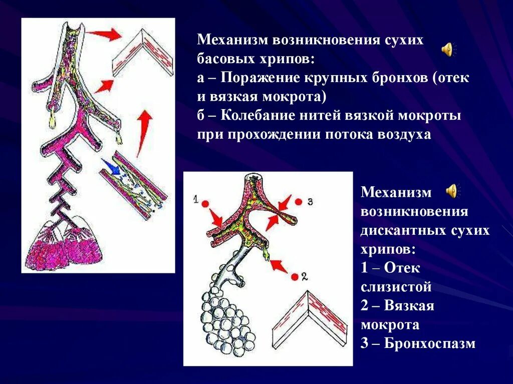 Звонкие хрипы. Механизм развития сухих хрипов. Механизм возникновения сухих басовых хрипов. Механизм возникновения сухих свистящих хрипов. Механизм образования сухих и влажных хрипов.