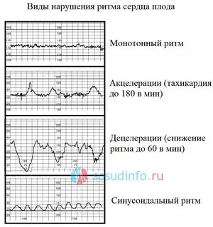 Тахикардия у плода по данным ктг проявляется