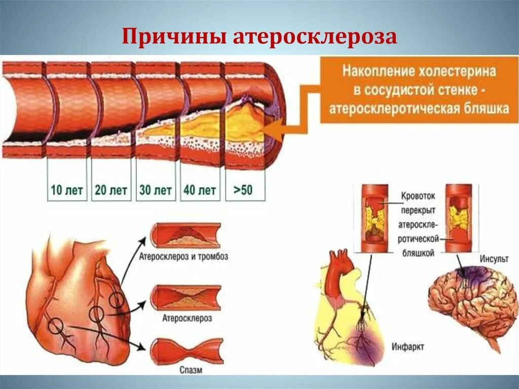 Лишний холестерин. Факторы возникновения атеросклероза. Факторы вызывающие атеросклероз. Причины появления атеросклероза.