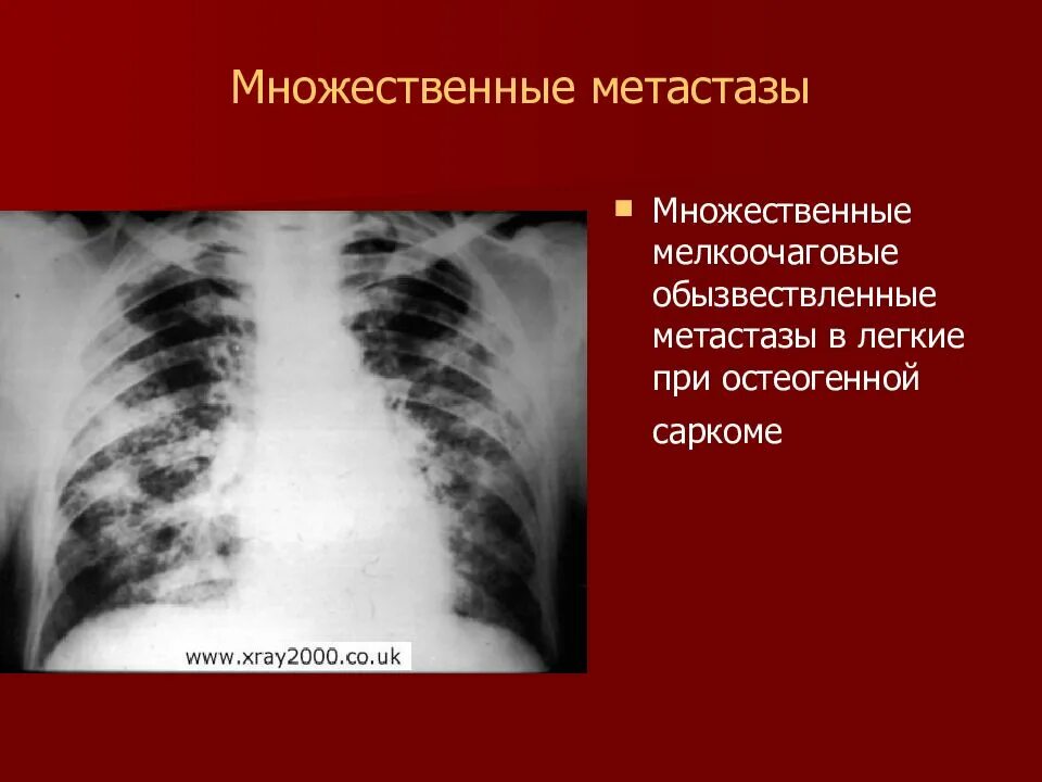 Гематогенные метастазы в легких рентген. Метастазы в легких рентген. Метастазы в легкие рентген. Признаки метастаз в легких