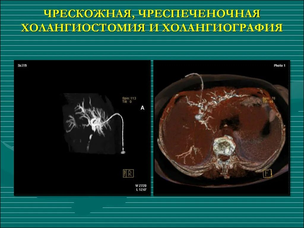Чрескожная чреспеченочная холангиостомия. Чркзкожная чрезпеченочная холангиангиография. Чрескожная чреспеченочная холангиография (ччхг). Чрескожная чреспеченочная холангиопанкреатография. Чрескожная чреспеченочная холангиография (ччхг).