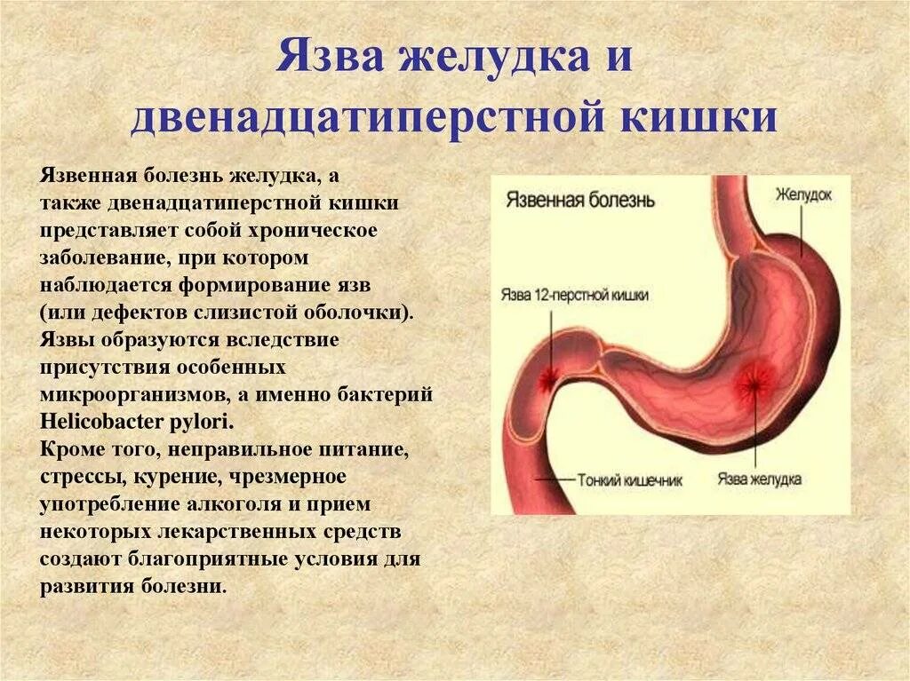 Язва дпк мкб. Язвенная болезнь желудка и 12 перстной. Язвенная болезнь желудка и 12 перстной кишки. Основные симптомы язвенной болезни желудка и 12-перстной кишки. Язвенная болезнь 12 перстной кишки симптомы.