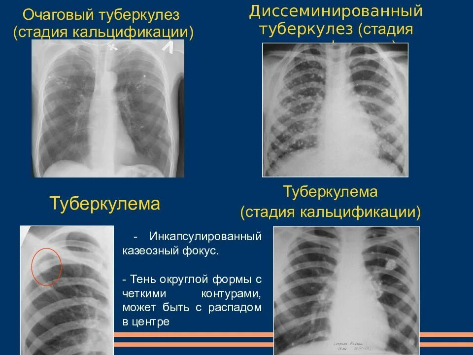 Очаговая форма туберкулеза. Диссеминированный инфильтративный туберкулез. Хронический очаговый туберкулез легких рентген. Очаговый туберкулёз ренген. Острый очаговый туберкулез рентген.