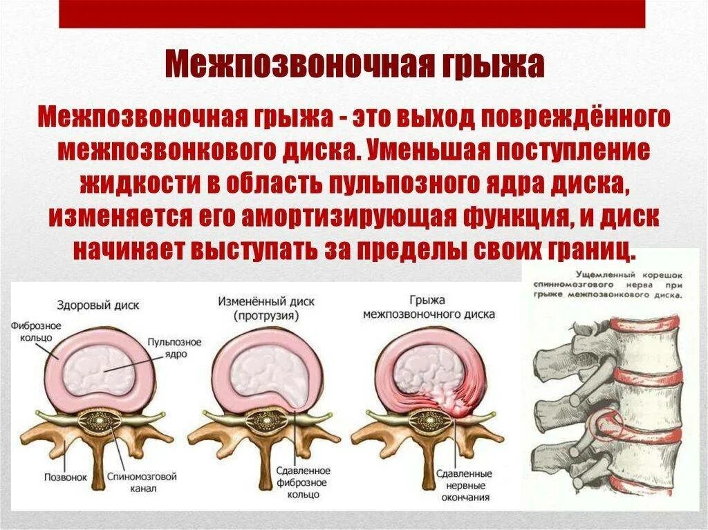 Протрузия шейного отдела позвоночника симптомы