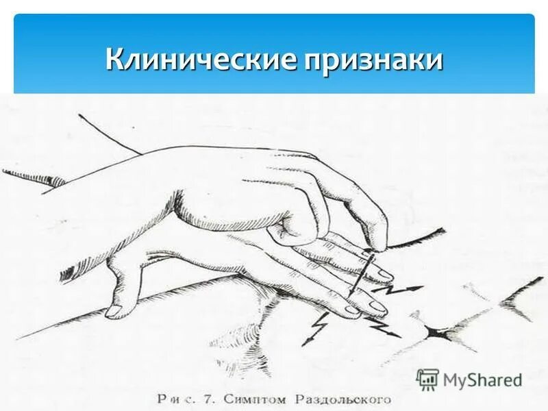На каком боку лежать при аппендиците. Симптом ситковского при остром аппендиците. : ровзинга, ситковского, михельсона. Симптомы воскресенского щеткина-блюмберга ровзинга ситковского. Симптом ситковского острого аппендицита.
