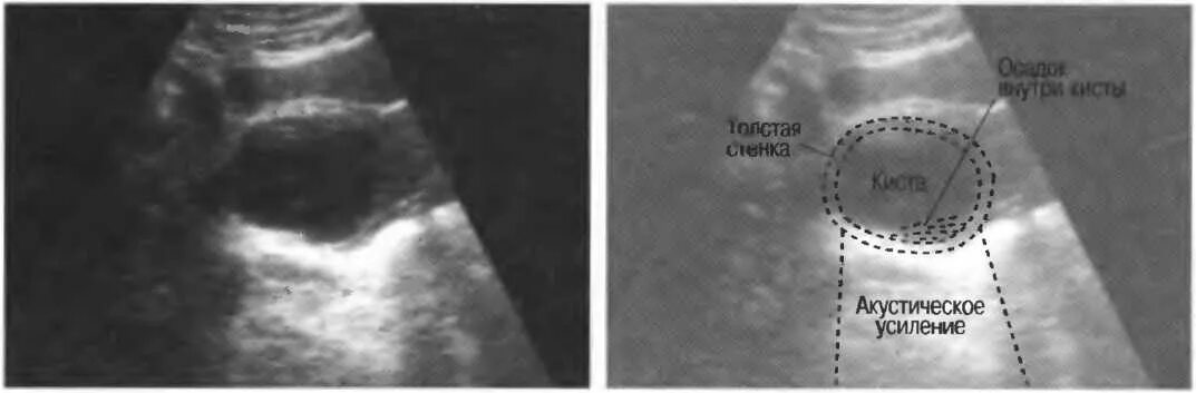 У мужчина киста будет. Акустическое усиление на УЗИ. Дистальное Акустическое усиление. Дистальное усиление на УЗИ это. Дистальное псевдоусиление на УЗИ.