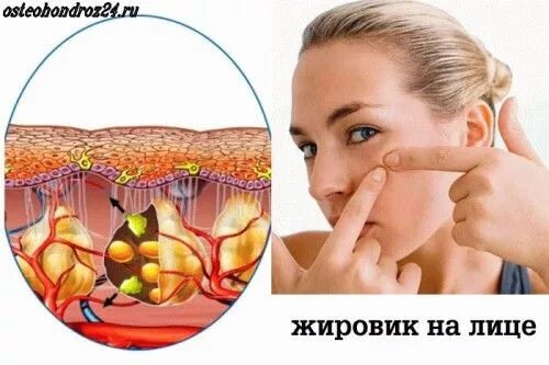 Клиника А2Мед предлагает лечение контагиозного моллюска.
