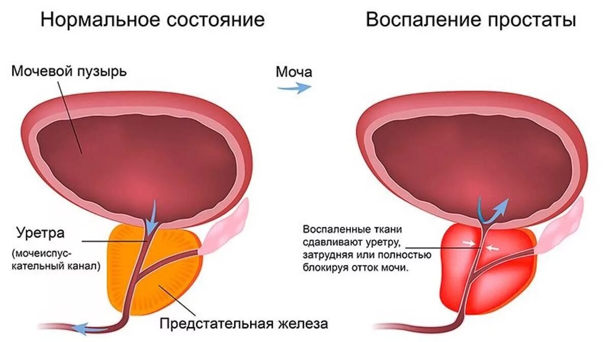 Фиброз простаты что это такое. Фиброз простаты что это такое