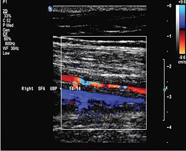Узи атеросклероз. Болезнь Такаясу УЗИ допплерография. Облитерирующий тромбангиит на УЗИ. Допплерометрия нижних конечностей.
