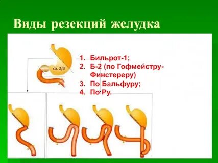 Бильрот 2 в модификации