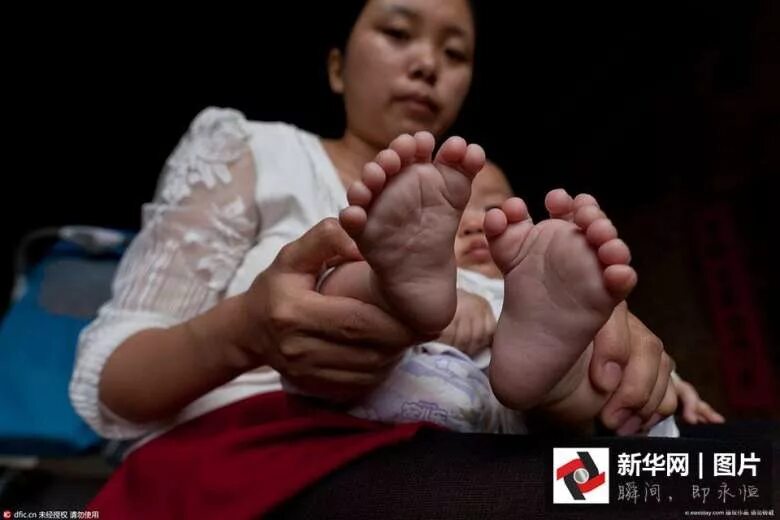 Родилась без ноги. Рождение детей без пальцев. Ноги младенцев в Китае.