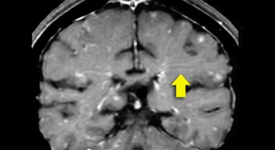 Сосудистый очаг в головном мозге что это. Фазекас мрт. Гиподенсивные очаги головного мозга что это такое. Перивентрикулярный отек мрт. Гиперденсивные очаги мрт.
